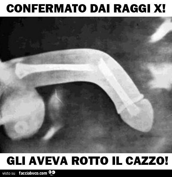 Confermato dai Raggi X. Gli aveva rotto il cazzo