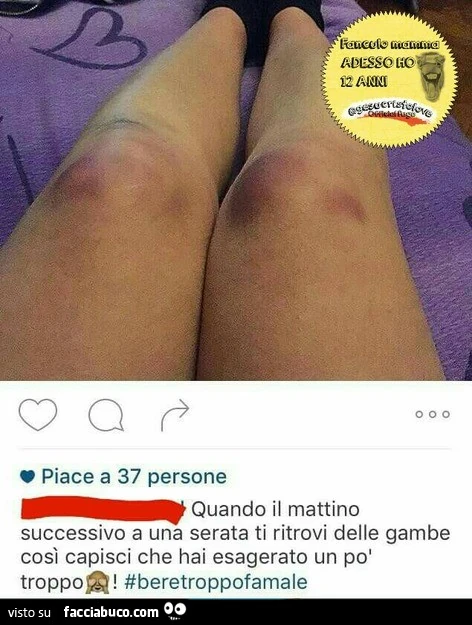 Quando il mattino successivo a una serata ti ritrovi delle gambe così capisci che hai esagerato un po' troppo